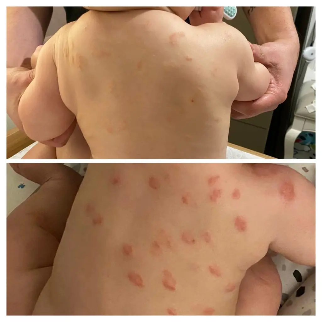 Infantile Eczema