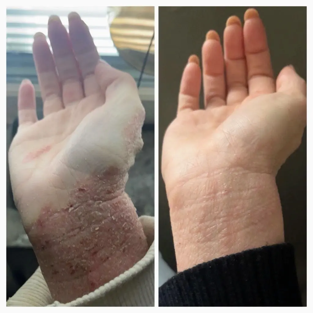 Topical Steroid Withdrawal