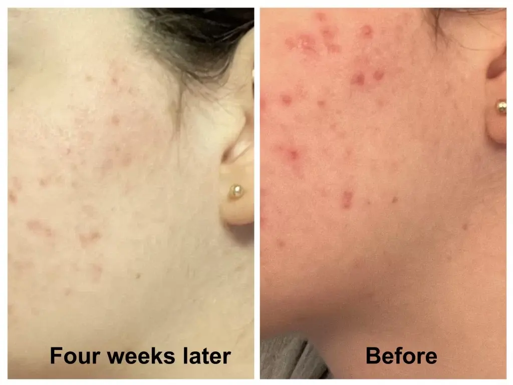 Homeopathic remedies for acne