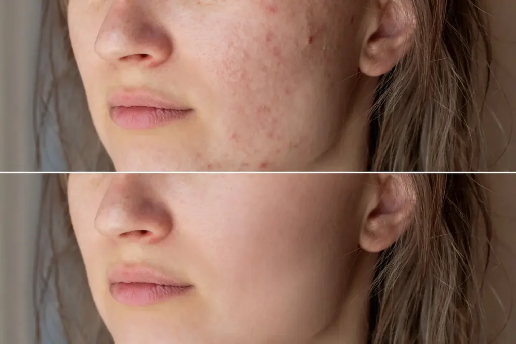 Homeopathic treatment for acne