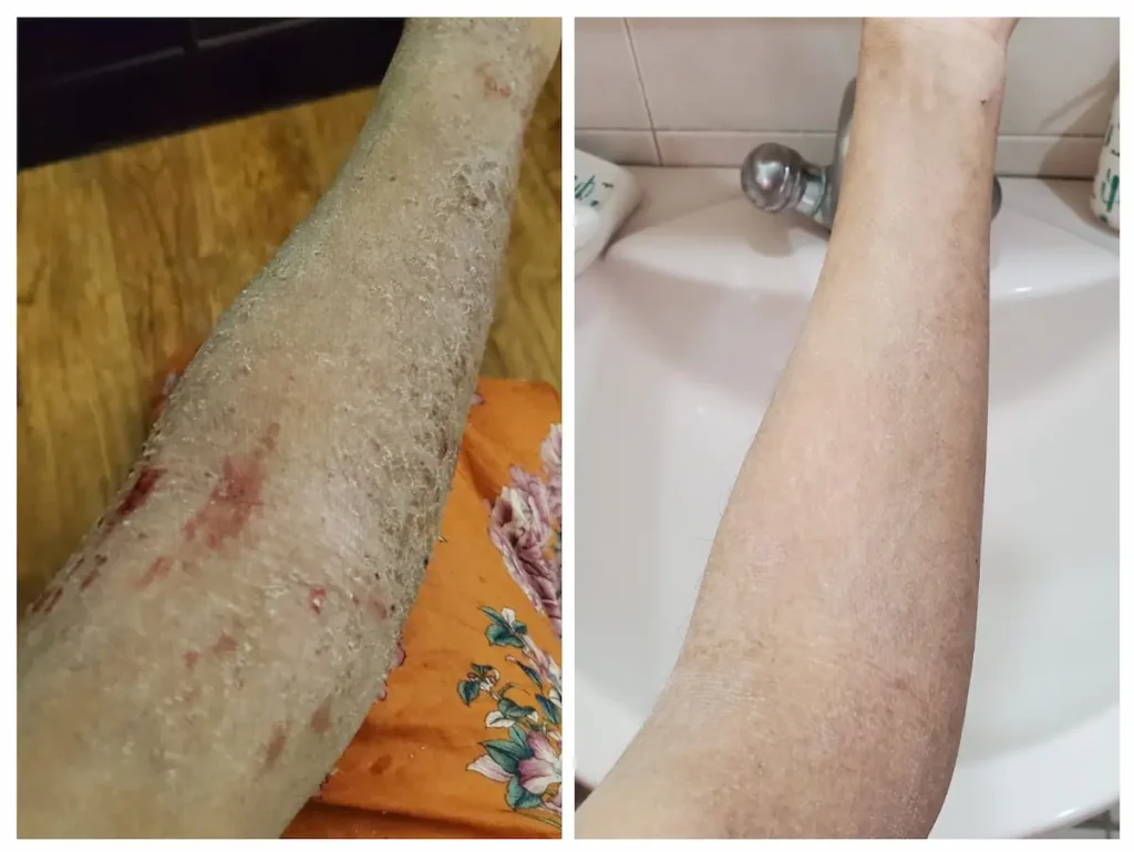 Neurodermatitis - Homeopathic Treatment