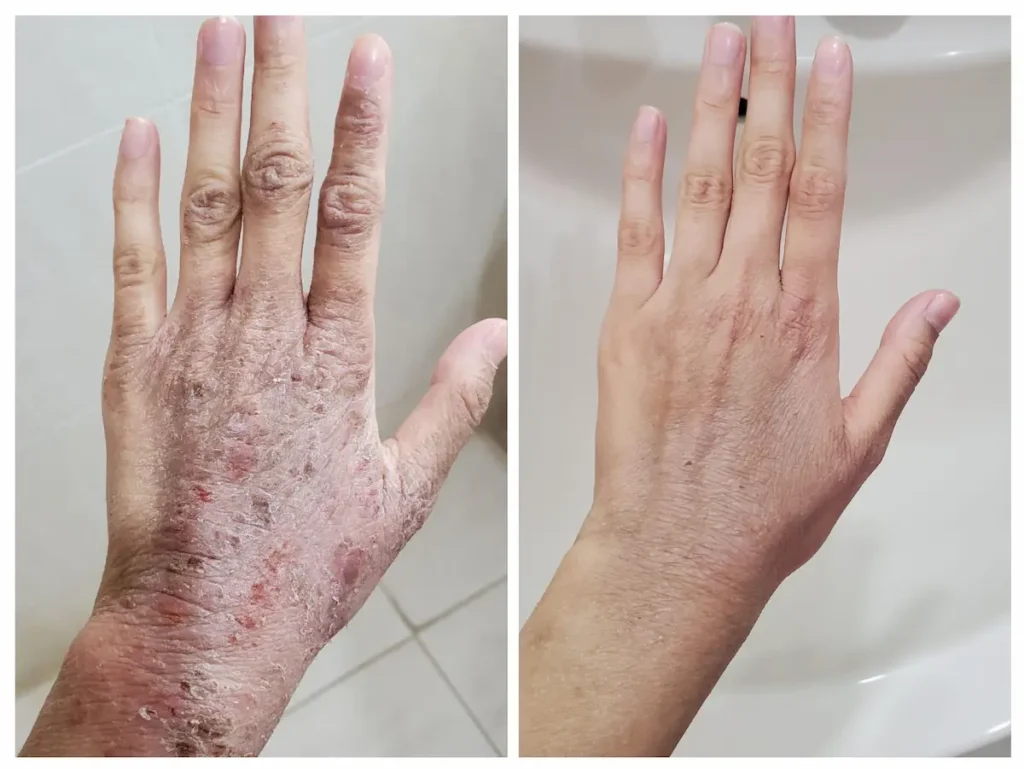 Atopic dermatitis - Homeopathic Treatment