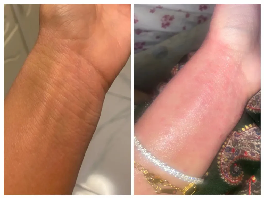 Contact dermatitis - Homeopathic treatment