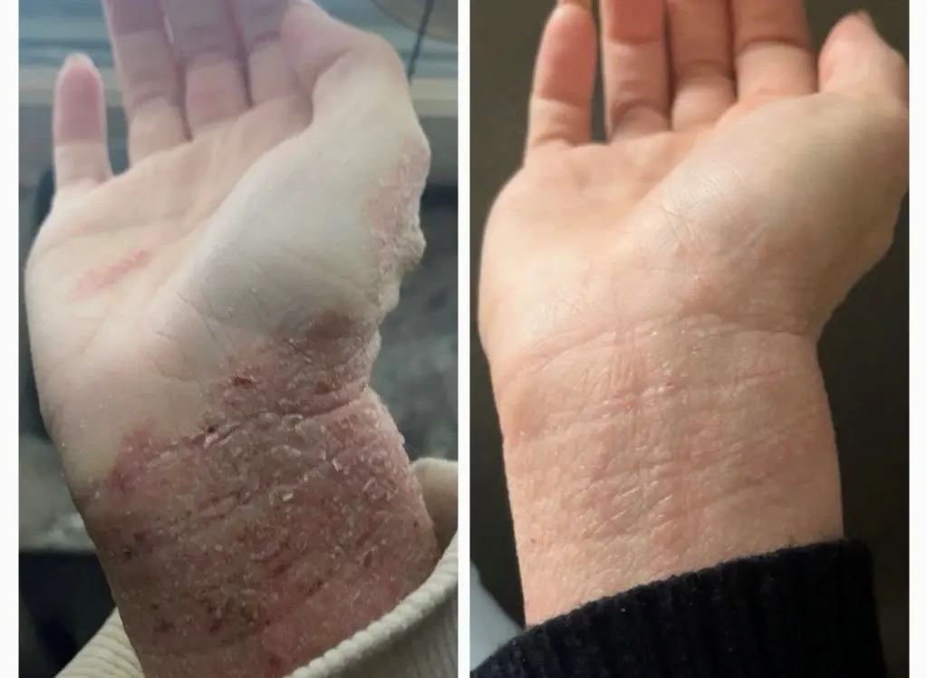 Topical Steroid Withdrawal - Homeopathic Treatment